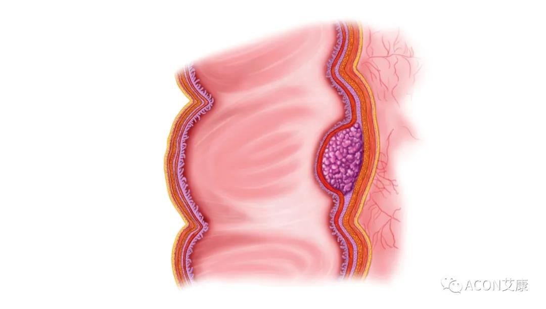 因为忽视身体出现的这些变化，他们最后被确诊结肠癌