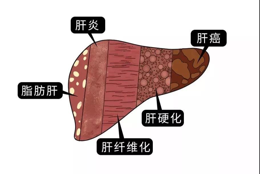 脂肪肝的最大敌人不是肥胖，答案竟是这样！