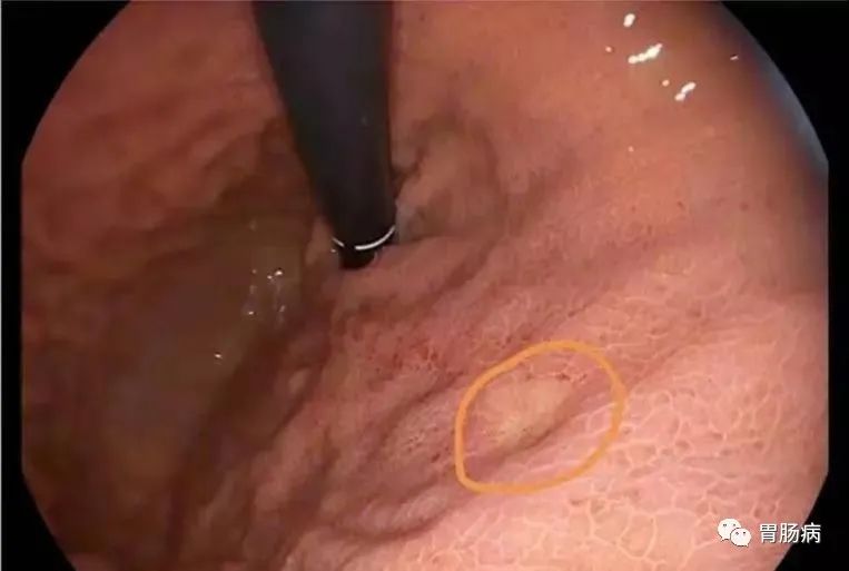 医生总结了3位年轻胃癌患者的病例:30岁不到的他们到底干啥了? 医生总结了3位年轻胃癌患者的病例:30岁不到的他们到底干啥了?