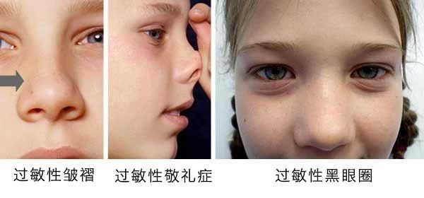 过敏性鼻炎会让孩子变傻？！家长该如何应对